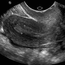 col uterin hiperplazie bazale adenoid